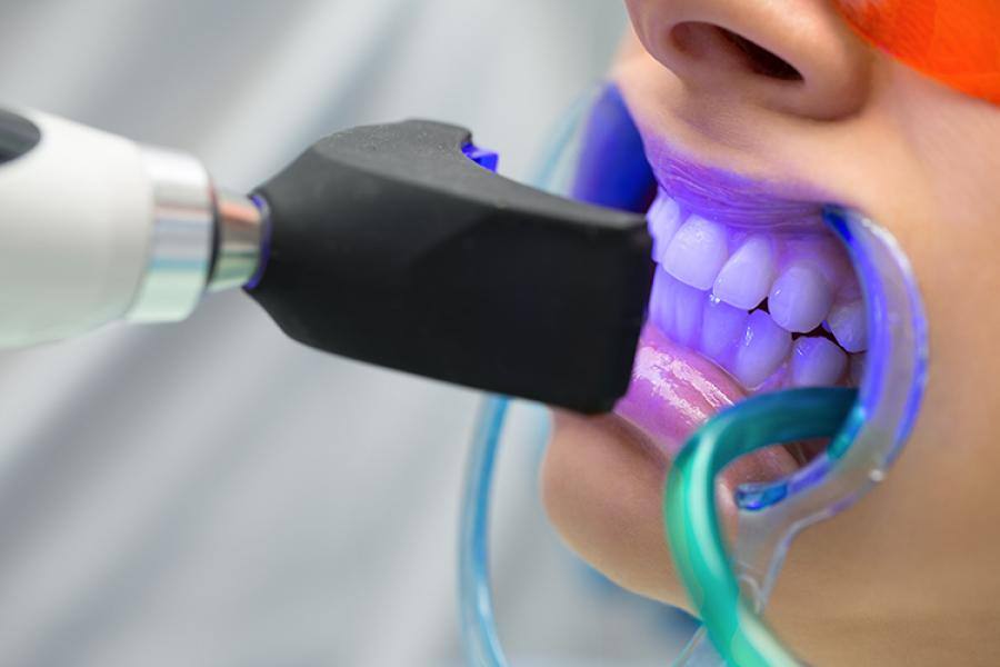 Diş Beyazlatma Sonucu Nasıl Korunur?