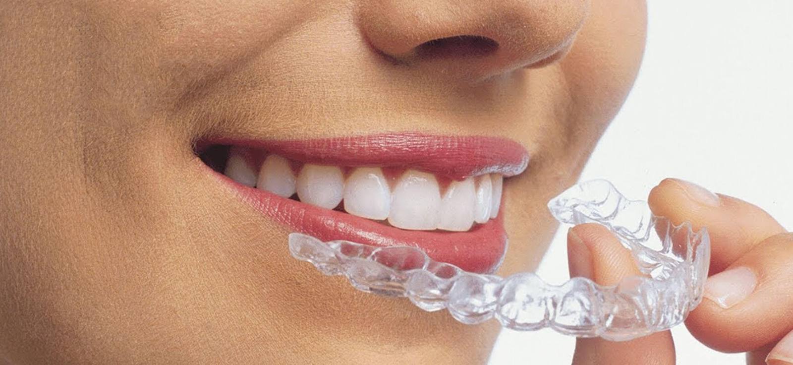 Şeffaf Plak ile Diş Düzeltme Süreci