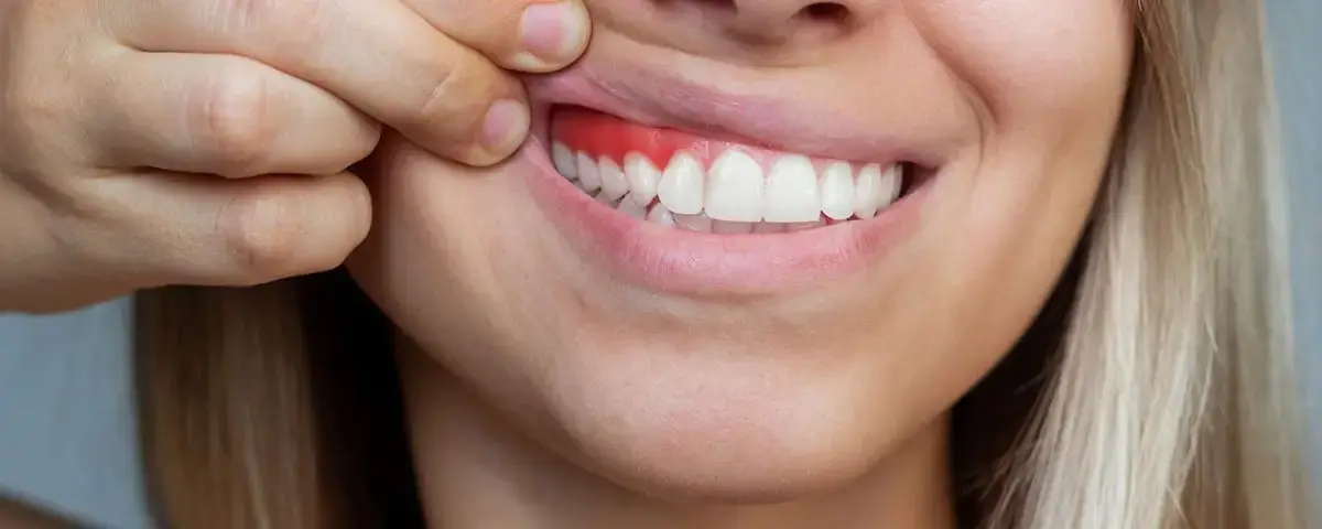 Diş Eti Kanaması Ciddiye Alınmalı Mı?