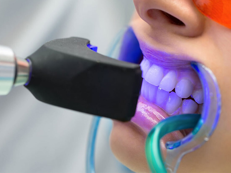 Diş Beyazlatma
